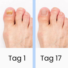 Lade das Bild in den Galerie-Viewer, DermaBlue™ Blaulicht Therapiegerät gegen Nagelpilz
