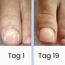 Lade das Bild in den Galerie-Viewer, DermaBlue™ Blaulicht Therapiegerät gegen Nagelpilz
