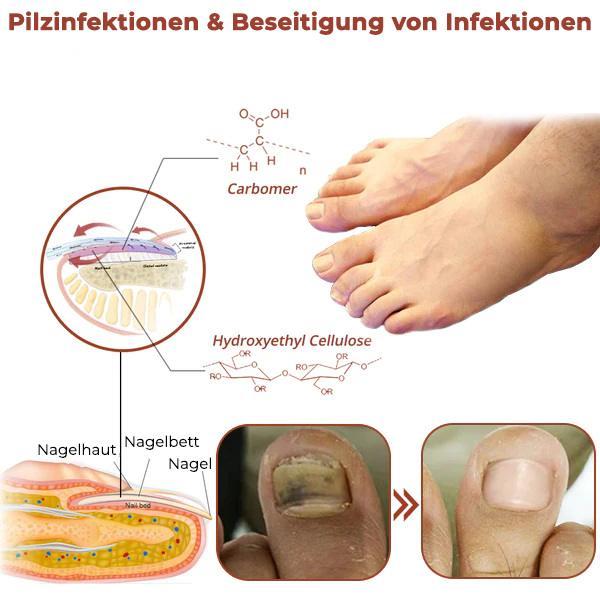 LLLT Nagelpilz - Revolutionäres hocheffizientes Lichttherapiegerät für Zehennagelkrankheiten, 2