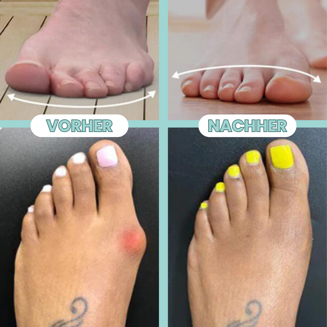 NEU - Orthopädische Ballenkorrektur für den Hallux Valgus