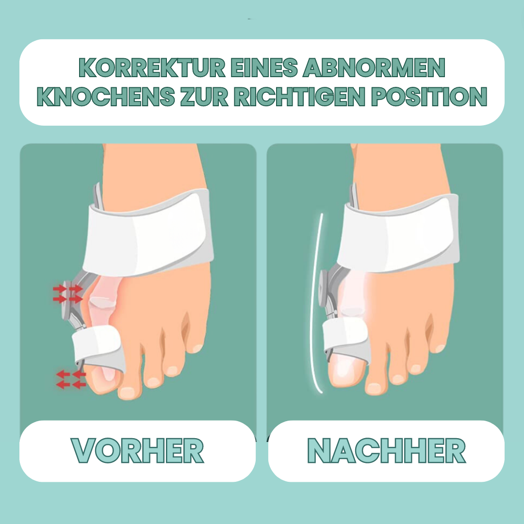 NEU - Orthopädische Ballenkorrektur für den Hallux Valgus