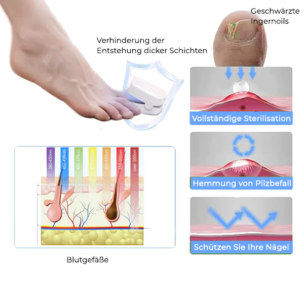 LLLT Nagelpilz - Revolutionäres hocheffizientes Lichttherapiegerät für Zehennagelkrankheiten, 3