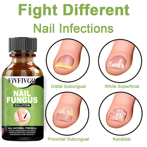 Nagelpilz Lösung- Gel zur Entfernung von Paronychie