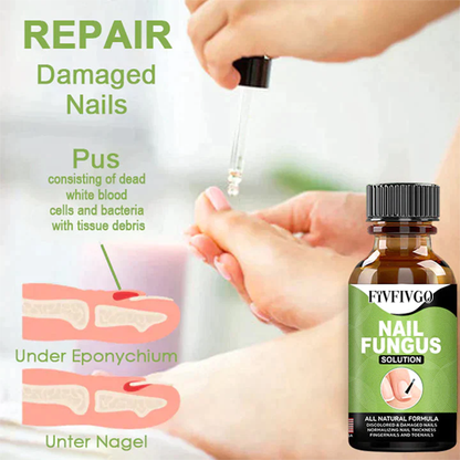 Nagelpilz Lösung- Gel zur Entfernung von Paronychie