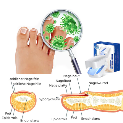 LLLT Nagelpilz - Revolutionäres hocheffizientes Lichttherapiegerät für Zehennagelkrankheiten, 4