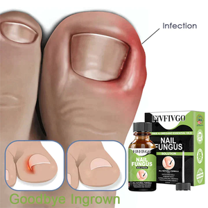 Nagelpilz Lösung- Gel zur Entfernung von Paronychie