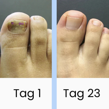 Lade das Bild in den Galerie-Viewer, DermaBlue™ Blaulicht Therapiegerät gegen Nagelpilz
