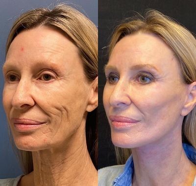 YoungMe - Kollagen Boost Anti-Aging Serum