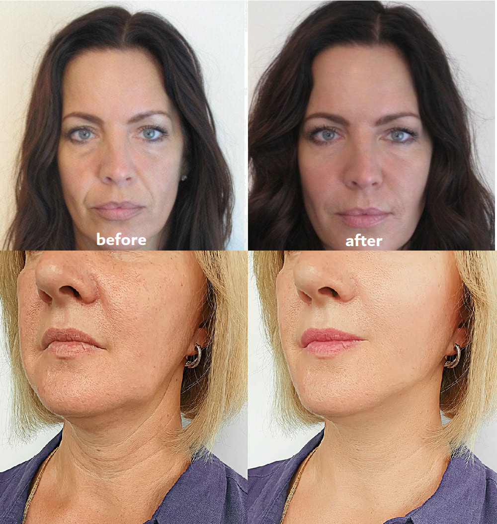 ANTI-FALTEN-PADS | 50% RABATT HEUTE