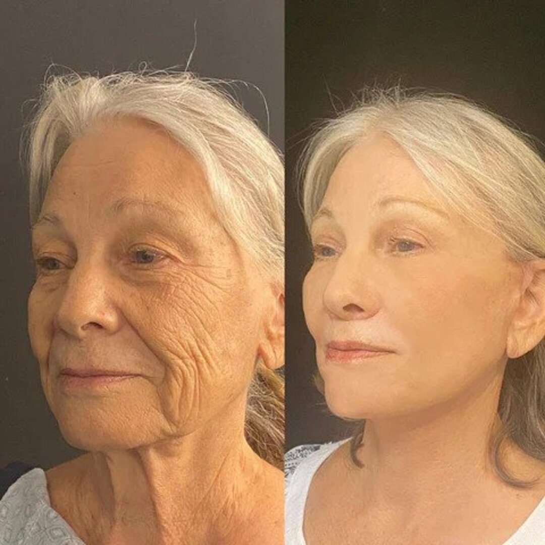 1+1 GRATIS | Exzellentes Anti-Falten Serum