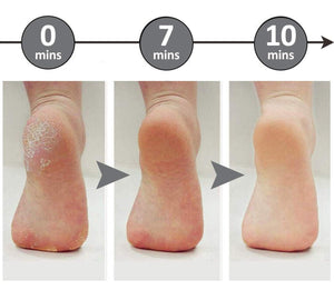 Soft Feet™ | Nie wieder Schwielen an den Füßen!