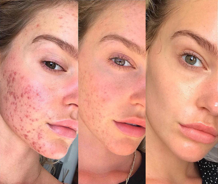 DarsonvalBlue™ 4 in 1 Hochfrequenz-Set | Für eine jüngere und gesündere Haut