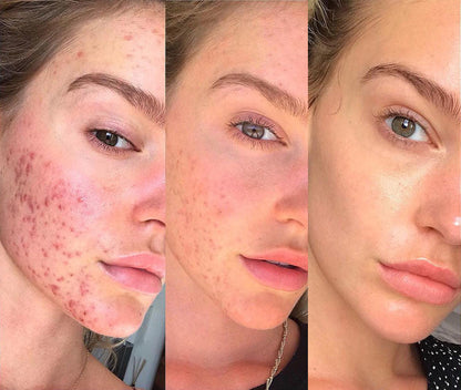 DarsonvalBlue™ 4 in 1 Hochfrequenz-Set | Für eine jüngere und gesündere Haut